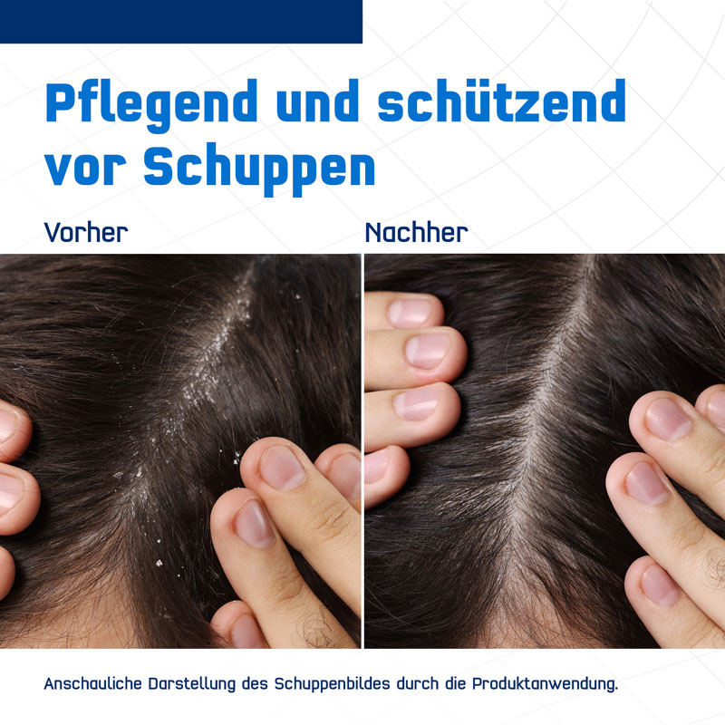 TERZOLIN Expert Schuppen-Shampoo bei fettiger Kopfhaut 200 ml Shampoo