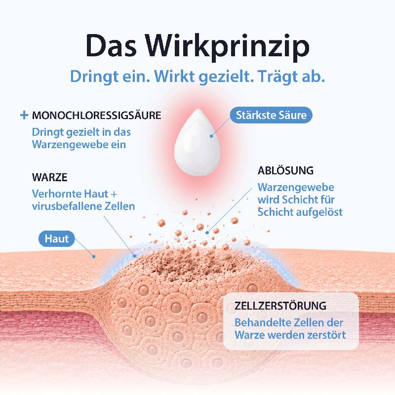 Acetocaustin Warzenmittel  2 ml Lösung