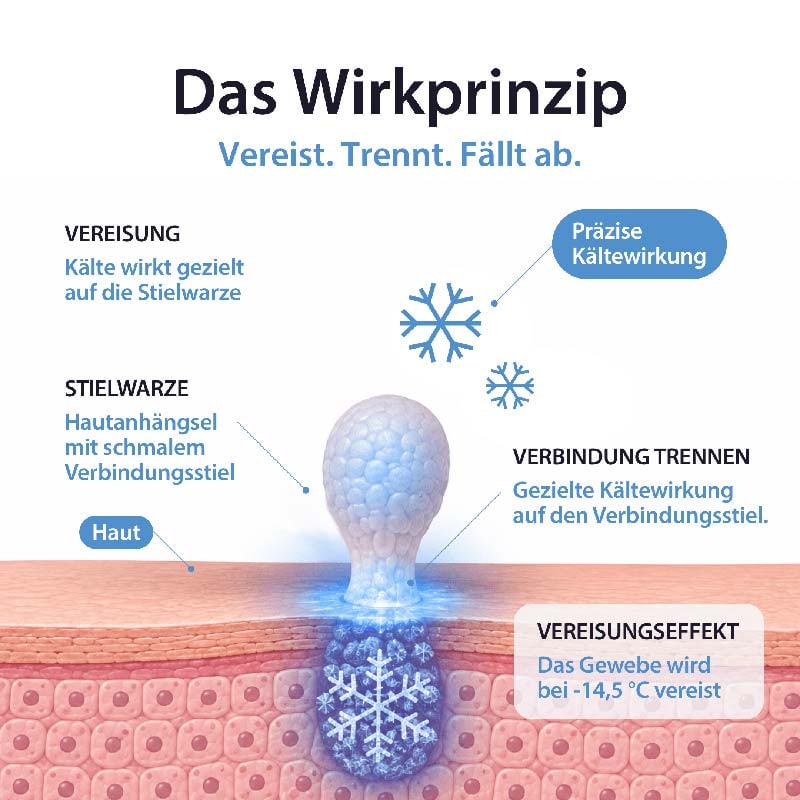 Acetocaustin Stielwarzen Entferner 50 ml Stifte