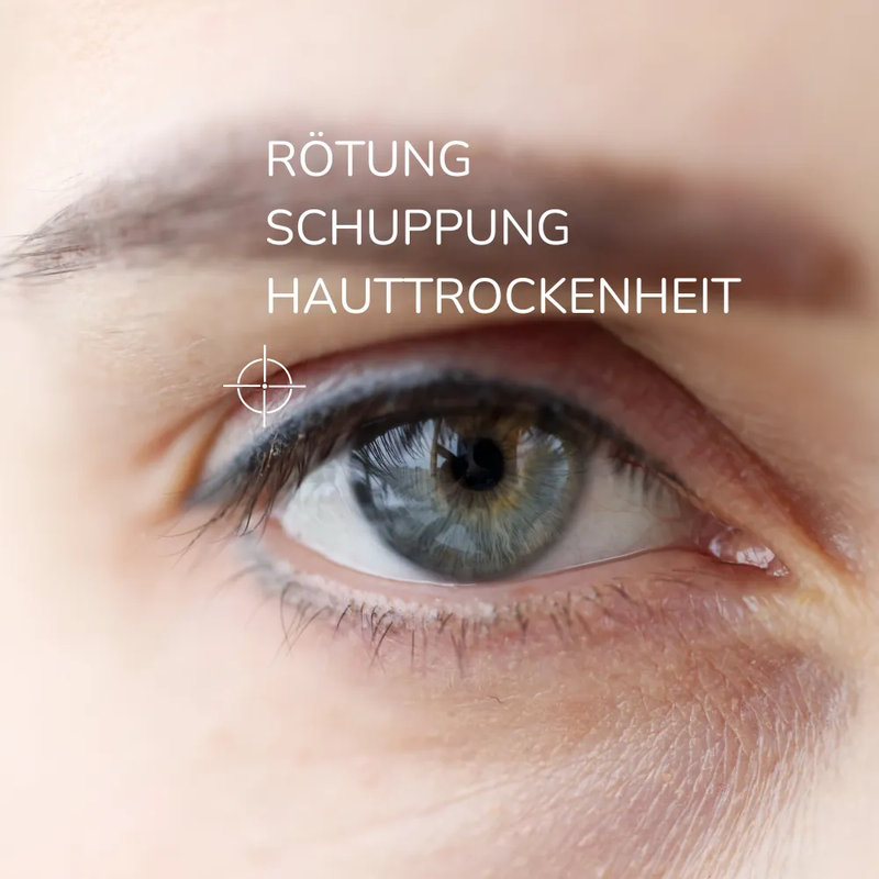 Allergika Augenlidcreme MED 15 ml Creme