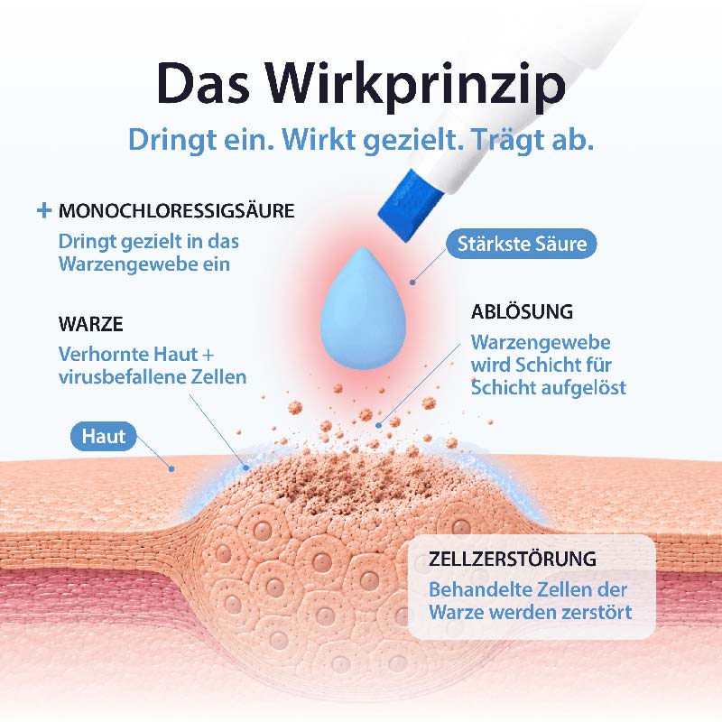 Acetocaustin Warzen Stift 3 ml Stifte