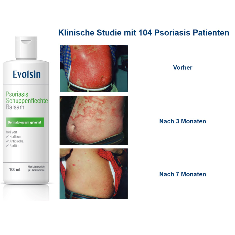 Evolsin Psoriasis Schuppenflechte Balsam 100 ml Balsam