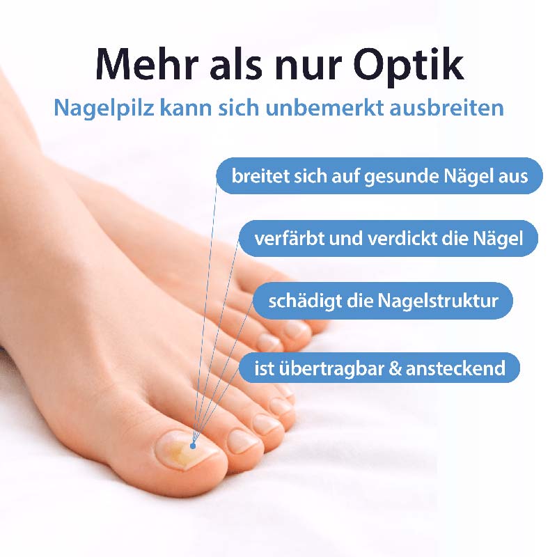 Acetocaustin Nagelpilz Lösung  5 ml Lösung