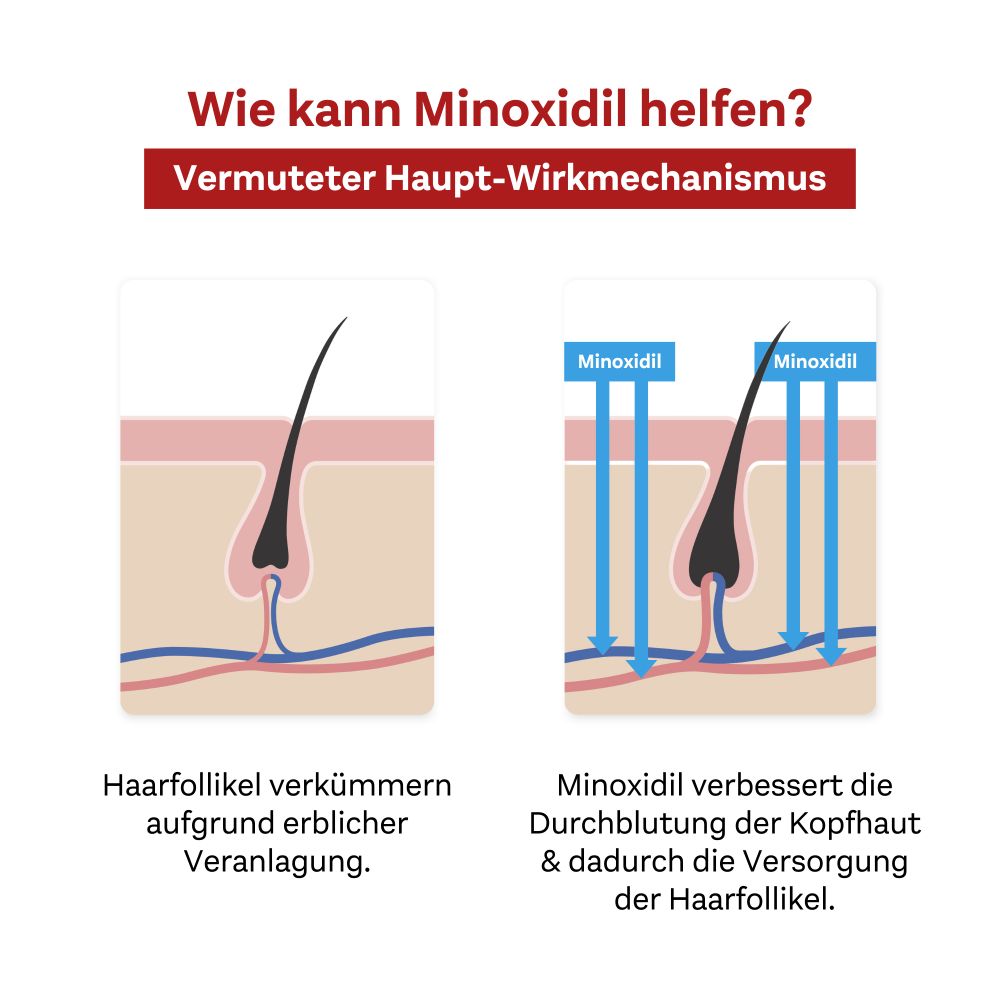 Doppelherz Pharma MINOXIDIL FÜR MÄNNER 3X60 ml Lösung