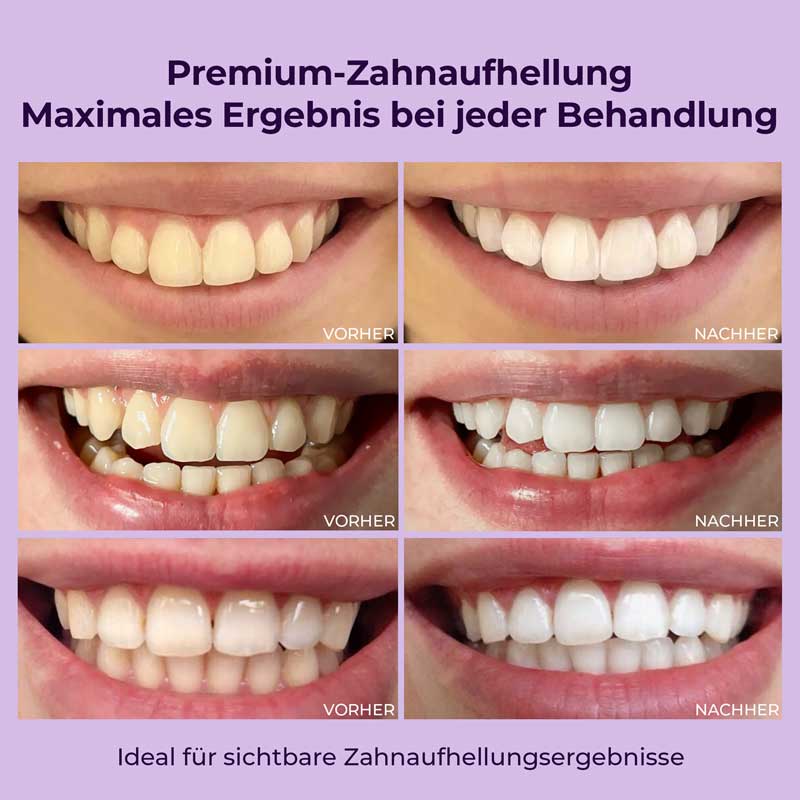 ZAHNAUFHELLUNGSSYSTEM - TEETH WHITENING SYSTEM 1 St Kombipackung